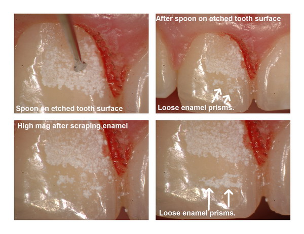 Gingivectomy and restoration Page5_resize.jpg